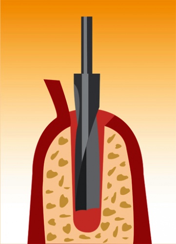 implantat1