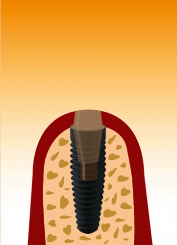 implantat3