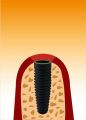 implantat2