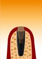 implantat3